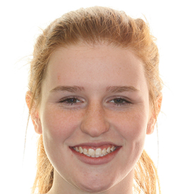 Orthodontic smile transformation before and after